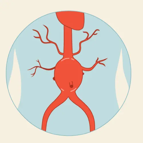 Aνεύρυσμα  Κοιλιακής  Αορτής | Παπουτσής Ιωακείμ  Αγγειοχειρουργός - Στρατιωτικός Ιατρός Θεσσαλονίκη