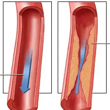 Στένωση Καρωτίδων | Παπουτσής Ιωακείμ  Αγγειοχειρουργός - Στρατιωτικός Ιατρός Θεσσαλονίκη