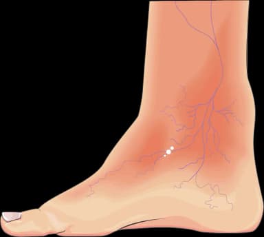 Διαβητικό Πόδι | Παπουτσής Ιωακείμ  Αγγειοχειρουργός - Στρατιωτικός Ιατρός Θεσσαλονίκη