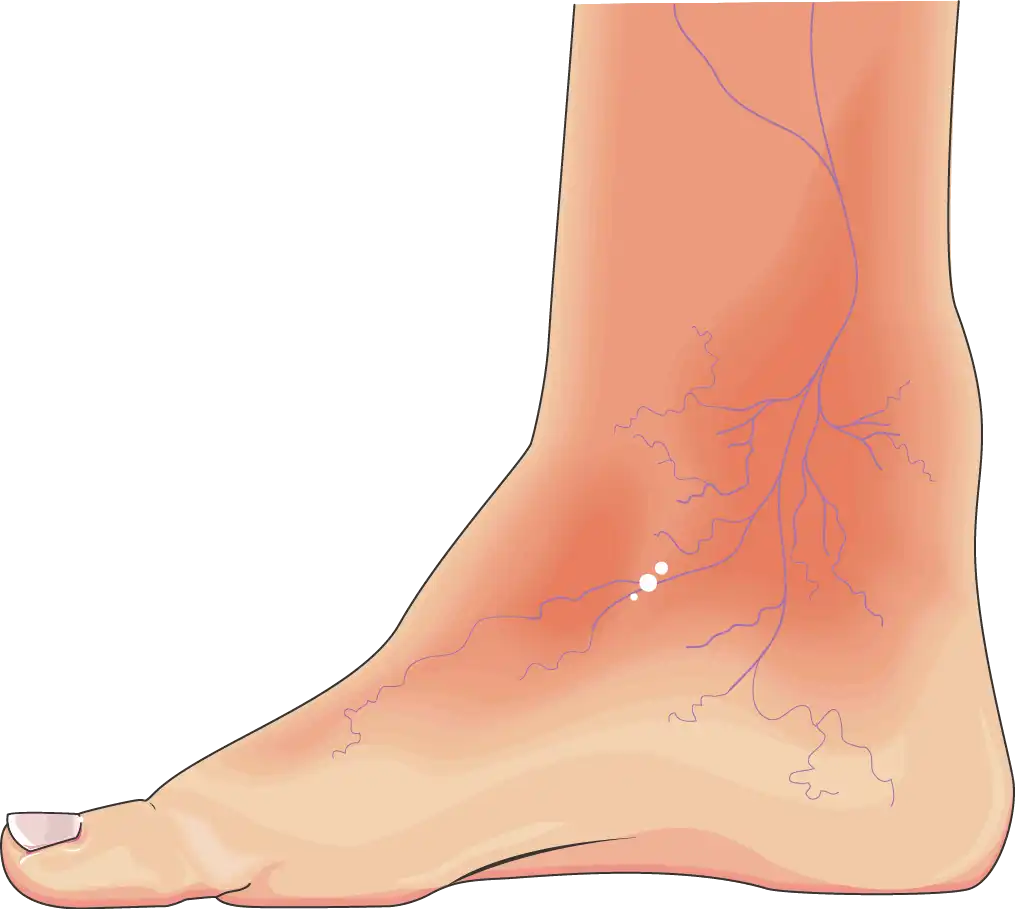 Διαβητικό Πόδι