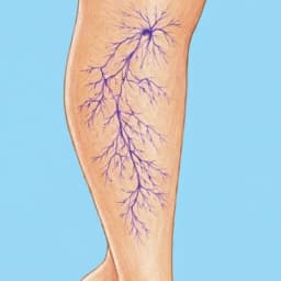 Ευρυαγγείες Κάτω Άκρων | Παπουτσής Ιωακείμ  Αγγειοχειρουργός - Στρατιωτικός Ιατρός Θεσσαλονίκη