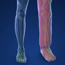 Λεμφοίδημα | Παπουτσής Ιωακείμ  Αγγειοχειρουργός - Στρατιωτικός Ιατρός Θεσσαλονίκη