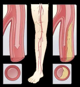 Στένωση & Απόφραξη Αρτηριών των Άκρων-Διαλείπουσα Χωλότητα | Παπουτσής Ιωακείμ  Αγγειοχειρουργός - Στρατιωτικός Ιατρός Θεσσαλονίκη