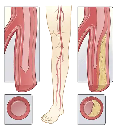 Στένωση & Απόφραξη Αρτηριών των Άκρων-Διαλείπουσα Χωλότητα | Παπουτσής Ιωακείμ  Αγγειοχειρουργός - Στρατιωτικός Ιατρός Θεσσαλονίκη