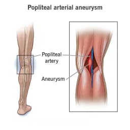 Ανεύρυσμα Ιγνυακής αρτηρίας | Παπουτσής Ιωακείμ  Αγγειοχειρουργός - Στρατιωτικός Ιατρός Θεσσαλονίκη