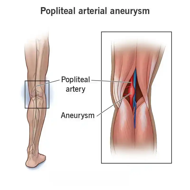 Ανεύρυσμα Ιγνυακής αρτηρίας