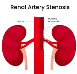 Στένωση Νεφρικών Αρτηριών | Παπουτσής Ιωακείμ  Αγγειοχειρουργός - Στρατιωτικός Ιατρός Θεσσαλονίκη
