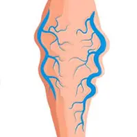 Κιρσοί Κάτω Άκρων – Φλεβική Ανεπάρκεια | Παπουτσής Ιωακείμ  Αγγειοχειρουργός - Στρατιωτικός Ιατρός Θεσσαλονίκη