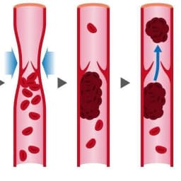 Φλεβική Θρόμβωση | Παπουτσής Ιωακείμ  Αγγειοχειρουργός - Στρατιωτικός Ιατρός Θεσσαλονίκη