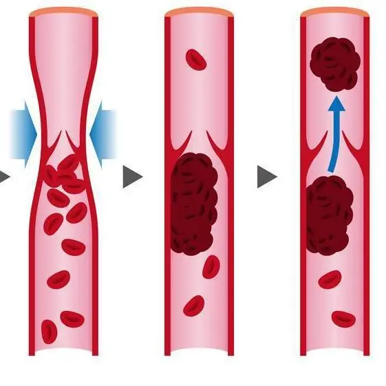 Φλεβική Θρόμβωση | Παπουτσής Ιωακείμ  Αγγειοχειρουργός - Στρατιωτικός Ιατρός Θεσσαλονίκη